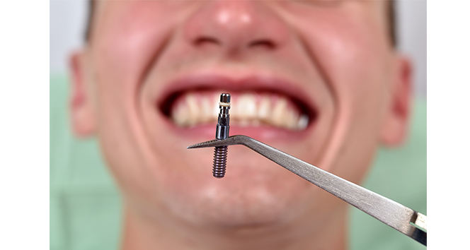 Ücretsiz implant tedavisi için Meclis’te kritik adım: İki şartla SGK kapsamına alınacak!