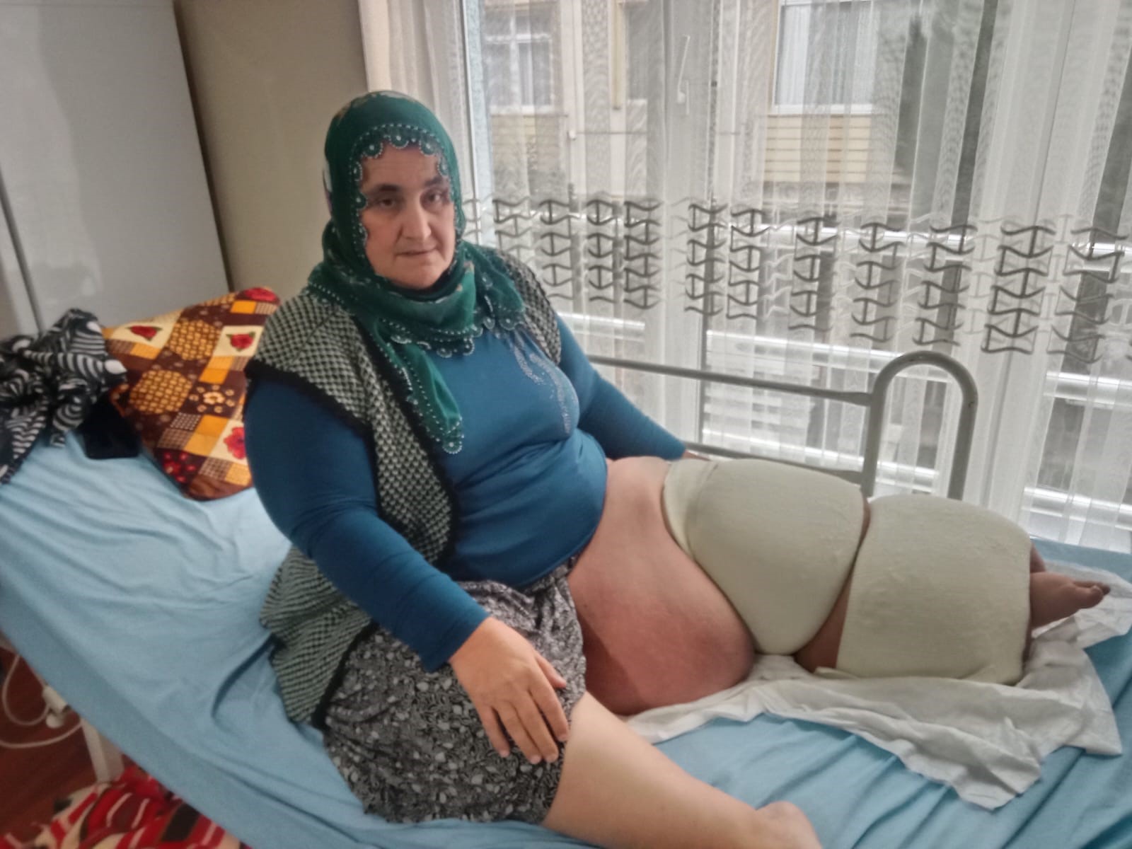 5 Yıllık Fil Hastalığı Hayatını Altüst Etti Bacağı 100 Kiloya Ulaştı!