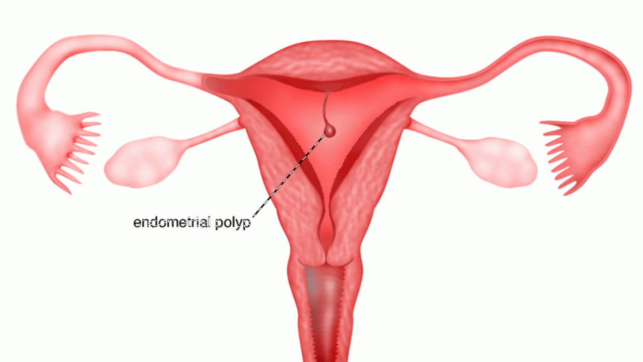 Polip nedir? Polip ne demek? Rahimde polip nedir? Polip Belirtileri ve tedavi yöntemleri nelerdir?