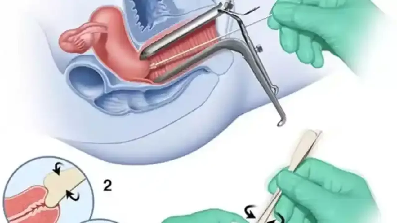 Smear Testi Nedir? Smear Testi Neden Yapılır? Kadınlarda smear testi nasıl yapılır?