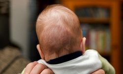 Bu belirtileri görürseniz dikkat! Çocuklarda Kraniosinostoz hayati risk taşıyabilir