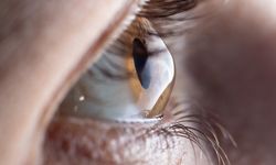 Keratokonus nedir? Neden olur? Tehlikeli midir?