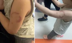 Edirne’de skandal iddia: Kreş öğretmeninin 3 yaşındaki çocuğu ısırdığı öne sürüldü