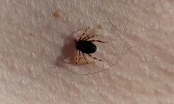 Uzmanından kene uyarısı! Bu yöntemleri asla kullanmayın