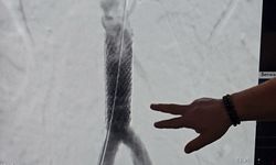 Milyonda bir görülen vaka! Öksürük nöbeti geçirdi, kalp damarı yırtıldı! Doktoru ölümcül tehlikeyi anlattı