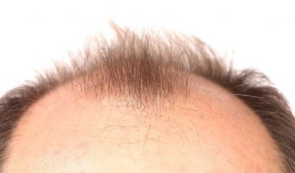 Saç dökülmesi ciddi bir sağlık sinyali olabilir: Uzmanından erken teşhis uyarısı