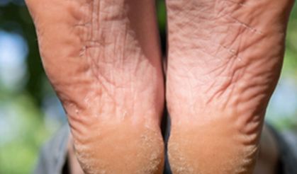 İki malzeme ile topuk çatlaklarına son! Pahalı ürünlere gerek yok, çözüm mutfağınızda!