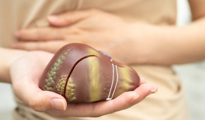 Belirtiler mide ağrısıyla karıştırılıyor: Safra taşlarına dikkat!