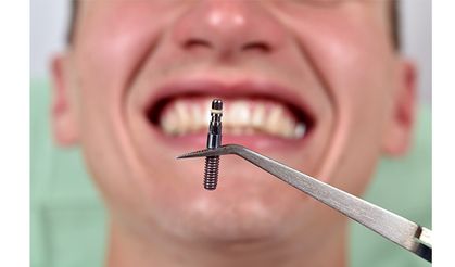 Ücretsiz implant tedavisi için Meclis’te kritik adım: İki şartla SGK kapsamına alınacak!