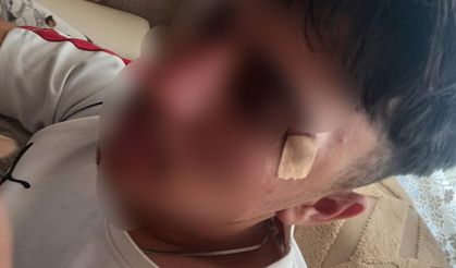 Afyonkarahisar’da öğretmenin öğrencisine kafa attığı iddia edildi: 16 yaşındaki çocuğun burnu kırıldı