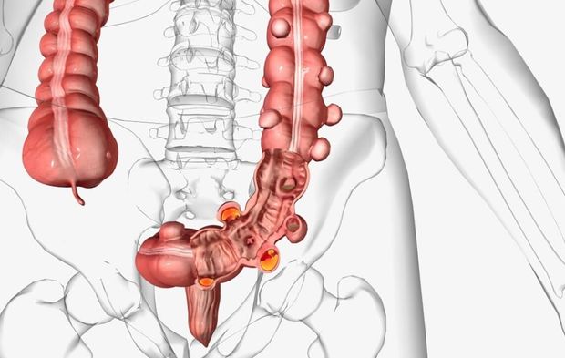 Kolon kanseri gençlerde hızla artıyor: vakalar son 30 yılda yüzde 100’den fazla yükseldi