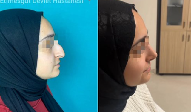 Servet ödemeye gerek kalmadı! Devlet hastanesinde yapılan estetik büyük ilgi gördü