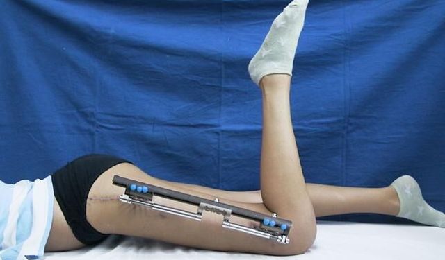 Boy uzatma ameliyatı sonrası yürüme etkilenir mi? Uzmanı yanıtladı