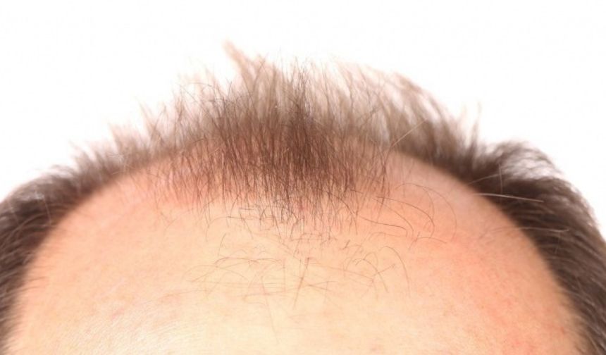 Saç dökülmesi ciddi bir sağlık sinyali olabilir: Uzmanından erken teşhis uyarısı