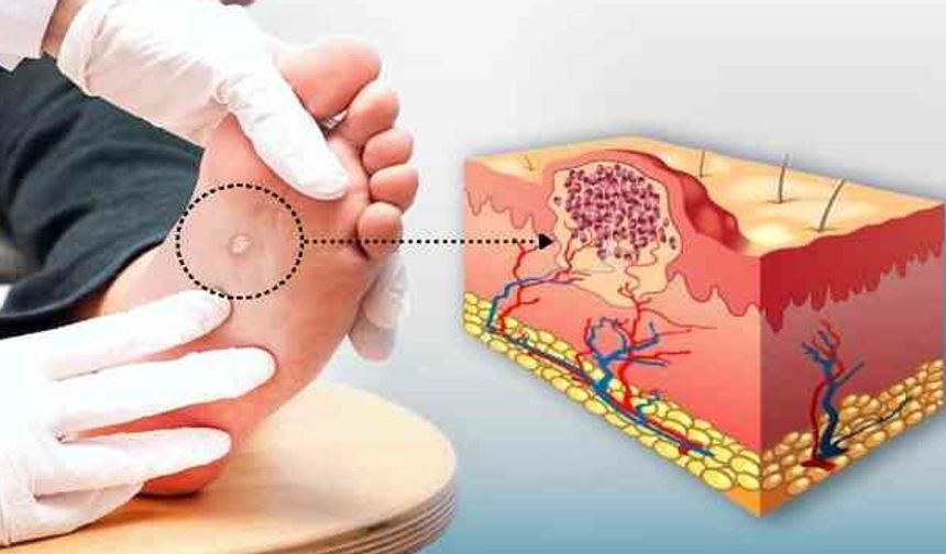 Siğil kâbusuna evdeki bu karışımla son! İşte, İbn-i Sina’nın Asırlık mucizevi formülü