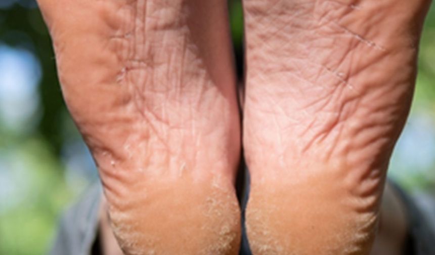 İki malzeme ile topuk çatlaklarına son! Pahalı ürünlere gerek yok, çözüm mutfağınızda!