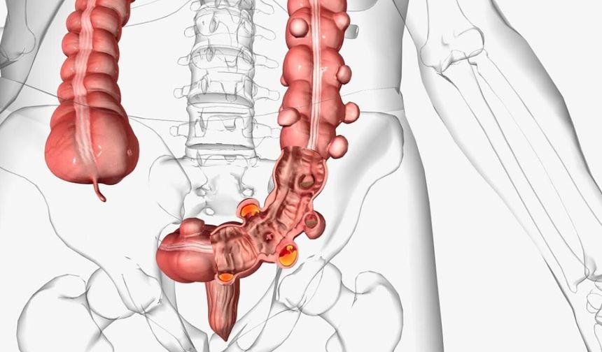 Kolon kanseri gençlerde hızla artıyor: vakalar son 30 yılda yüzde 100’den fazla yükseldi