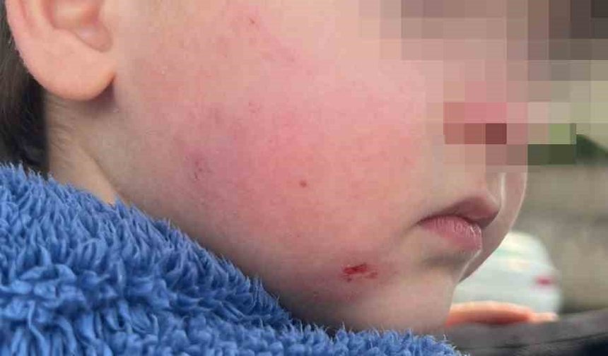 Bursa’da kreş skandalı: 2,5 yaşındaki çocuk darp edilmiş halde bulundu